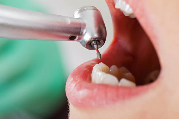 Best Walk-In Emergency Dentist in Mill Creek East, WA
